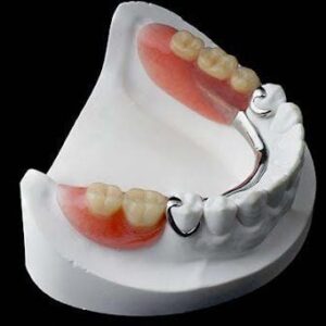 Detec Chromium-Cobalt (Cr-Co) Removable Partial Denture (RPD)