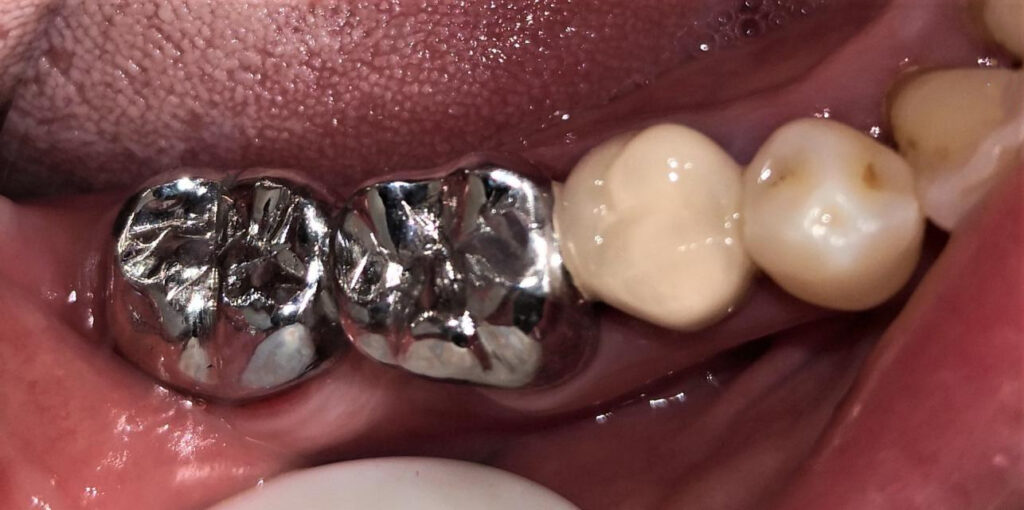 Chromium-Cobalt (Cr-Co) Crowns - Detec