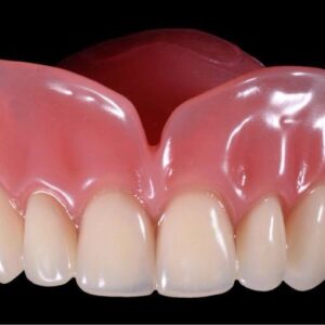 Detec Provisional Removable Overdenture