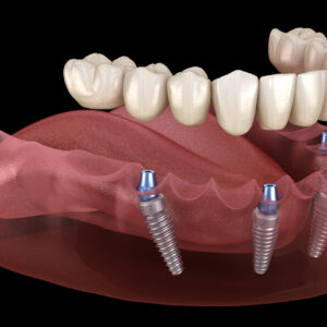Detec Full-Arch Porcelain-Fused-to-Titanium (PFT) Restoration on Abutments