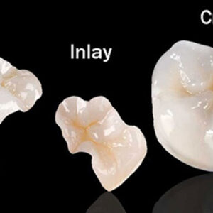 Detec Zirconia ST Inlays, Onlays, Overlays, and Core Buildups