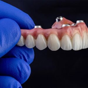 Detec All-on-4 Full-Arch Restoration with Direct Porcelain Buildup on Abutments